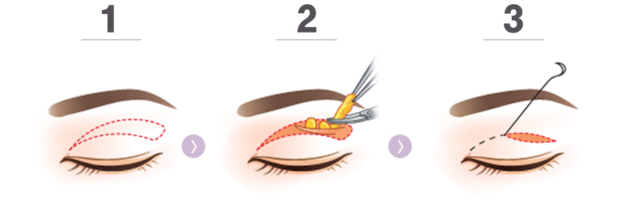 눈꼬리 내리기+뒤트임의 수술방법