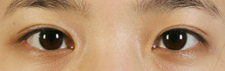 Thick Eyelids After