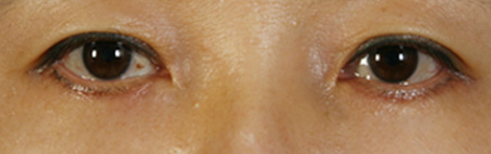 Wrinkled Lower Eyelids Before