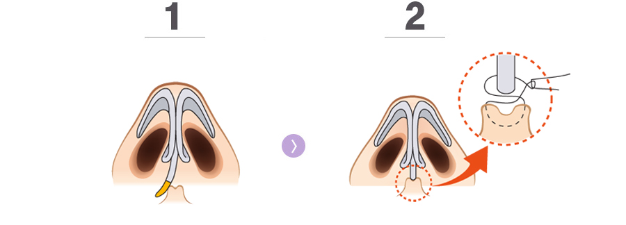 휜 코 수술 방법