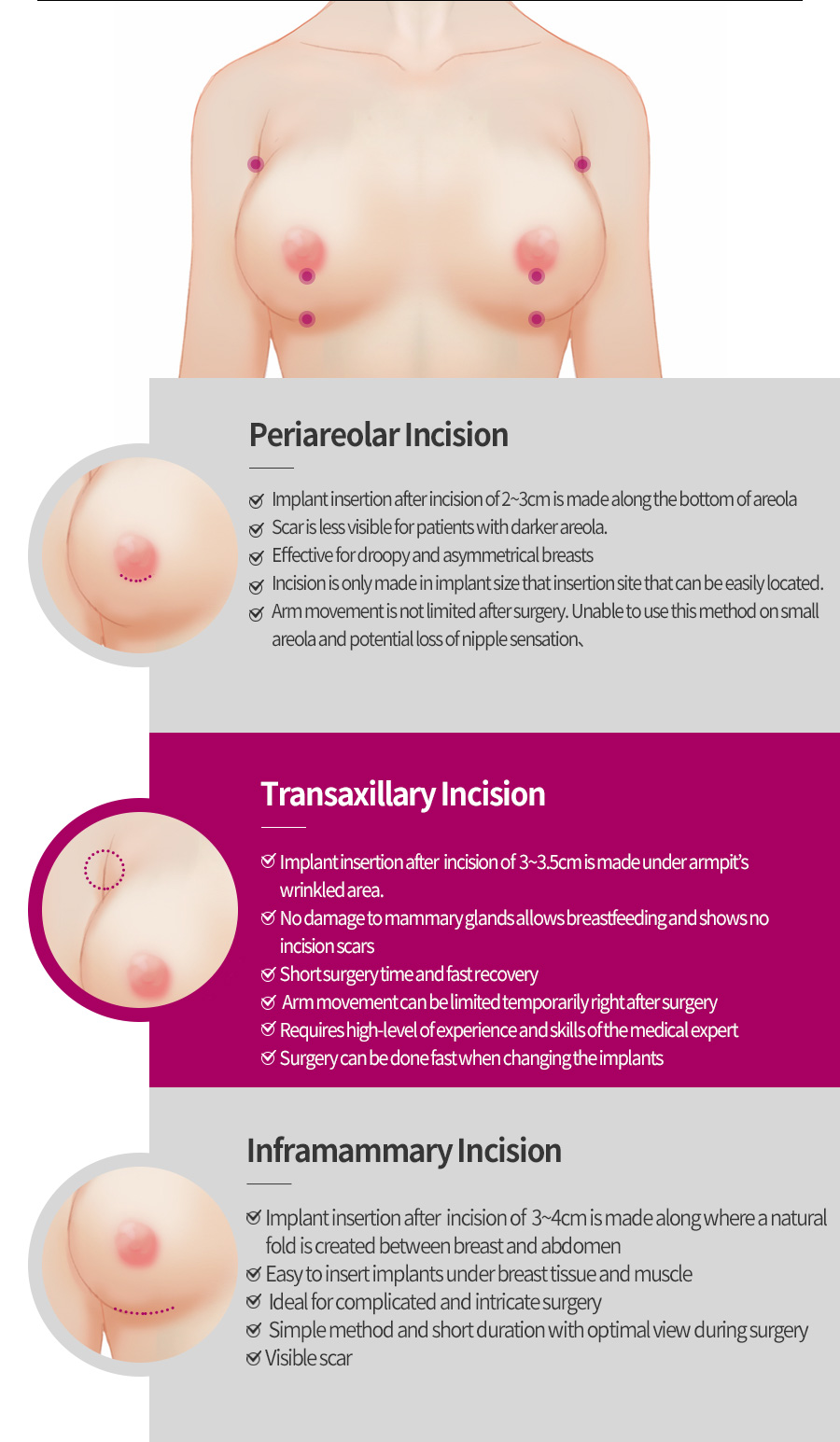 Periareolar Incision / Transaxillary Incision / Inframammary Incision