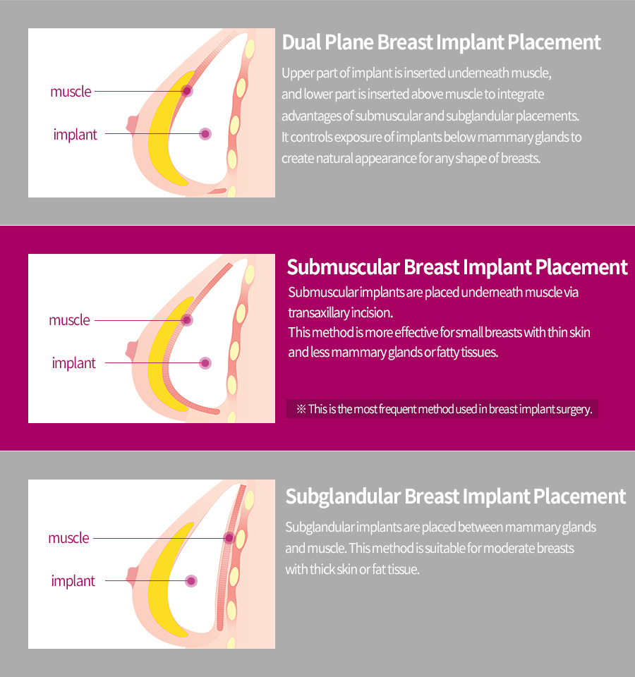 Dual Plane Breast Implant Placement / Submuscular Breast Implant Placement / Subglandular Breast Implant Placement