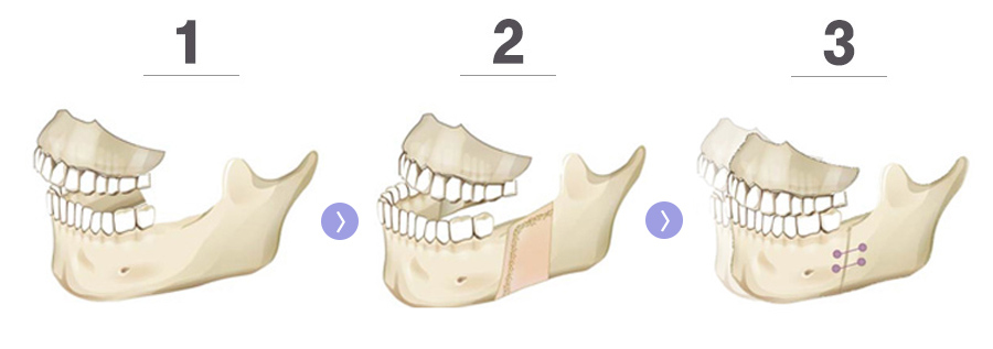 위턱(상악)과 아래턱(하악)의 뼈를 절골하여 동시에 수술한 뼈 사진이미지