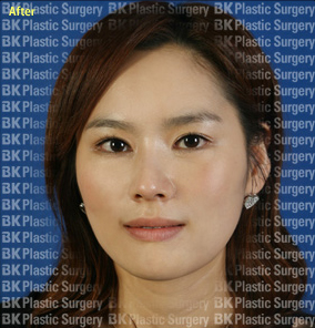 절개법 쌍꺼풀 수술+안검하수 근육수술,앞트임,눈꼬리내리기  후