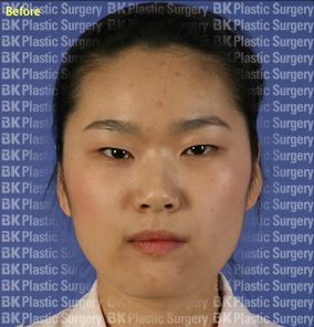 절개법 쌍꺼풀 수술+안검하수 근육수술,앞트임,눈꼬리내리기  전