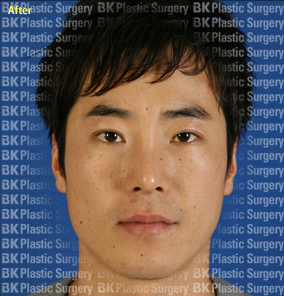 절개법 쌍꺼풀 수술+안검하수 근육수술,뒤트임,눈꼬리내리기  후