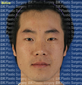 절개법 쌍꺼풀 수술+안검하수 근육수술,뒤트임,눈꼬리내리기  전