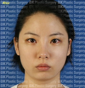 절개법 쌍꺼풀재수술 (안검하수 근육수술, 뒤트임, 눈꼬리내리기)  후