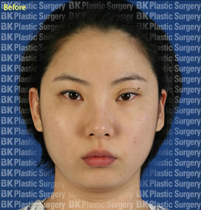 절개법 쌍꺼풀재수술 (안검하수 근육수술, 뒤트임, 눈꼬리내리기) 전