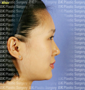 코끝수술(비중격을 이용한 코끝수술) 후1