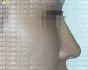 코높이는수술(실리콘 사용, 귀연골 이식) 후1