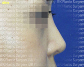 코높이는수술(실리콘 사용, 귀연골 이식, 짧은 코를 길게하는 수술) 후