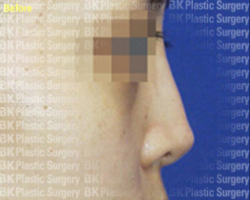 코높이는수술(실리콘 사용, 귀연골 이식, 짧은 코를 길게하는 수술) 전