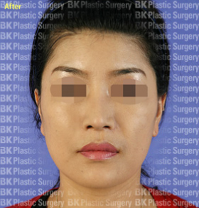 코높이는수술(실리콘 사용, 귀연골 이식, 콧볼줄이기, 짧은 코를 길게하는 수술) 후1