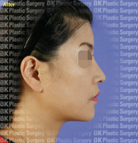 코높이는수술(실리콘 사용, 귀연골 이식, 콧볼줄이기, 짧은 코를 길게하는 수술) 후2