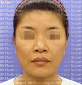 코높이는수술(실리콘 사용, 귀연골 이식, 콧볼줄이기, 짧은 코를 길게하는 수술) 전1