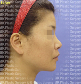 코높이는수술(실리콘 사용, 귀연골 이식, 콧볼줄이기, 짧은 코를 길게하는 수술) 전2