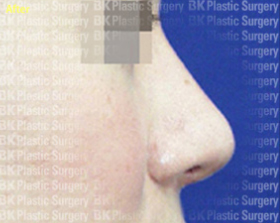 코 재수술(실리콘 사용,귀연골 이식,코비주름 밖으로 절개,전피지방 이식수술) 후